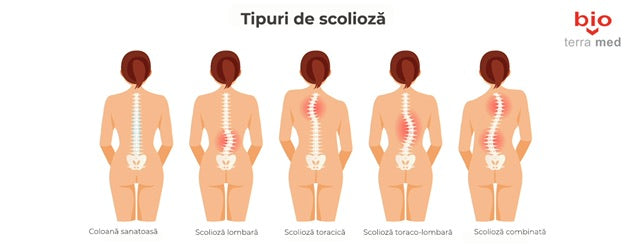 Tratament Scolioza: Ce este și cum o putem gestiona?