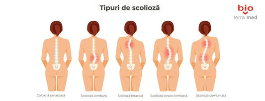 Tratament Scolioza: Ce este și cum o putem gestiona?