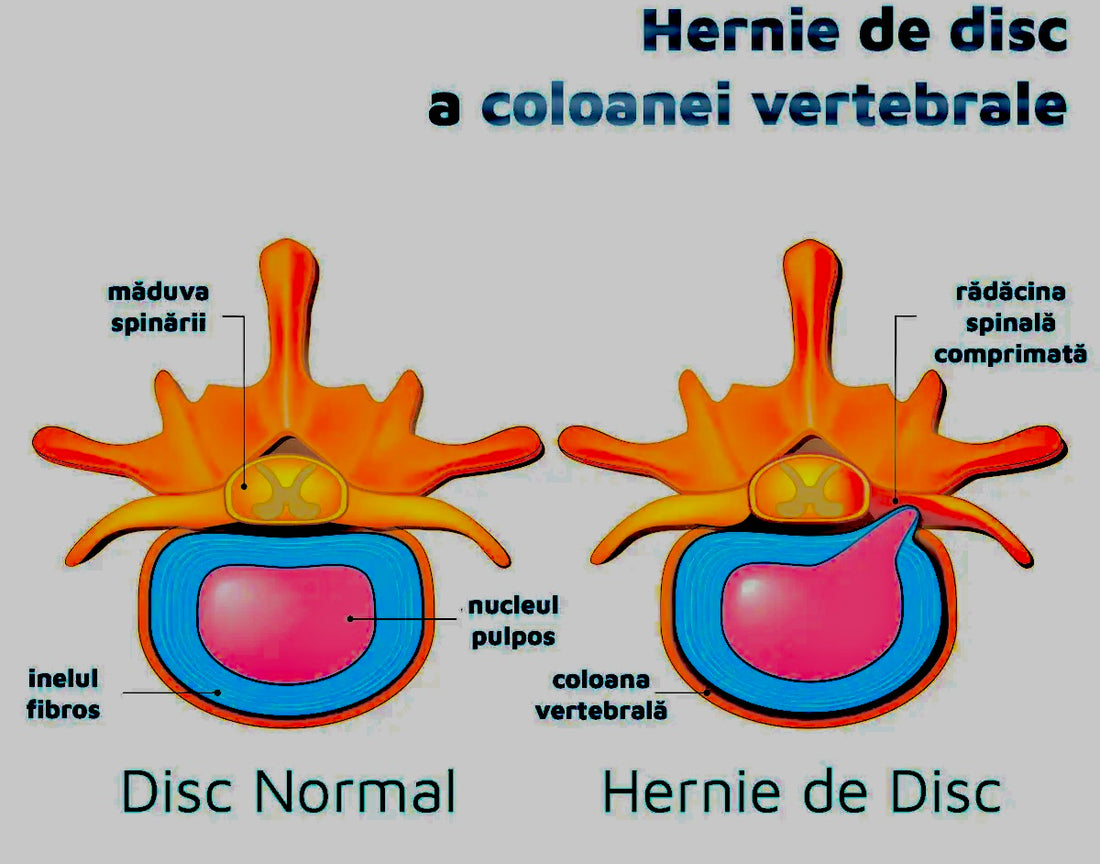 Hernie de disc ?