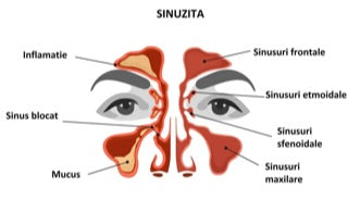 Sinuzita