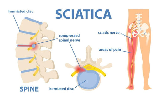 Criza de sciatica