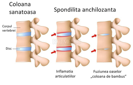 Spondilita anchilozanta