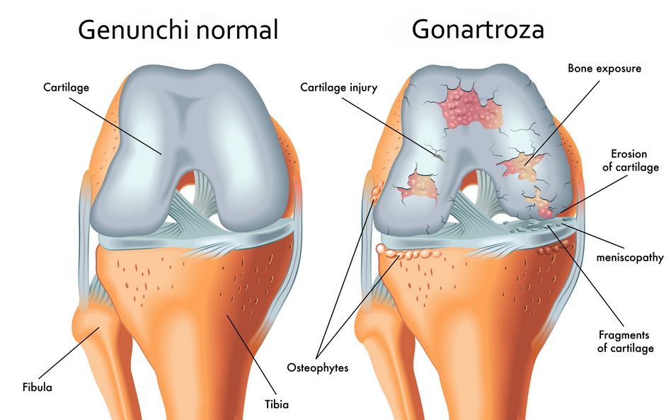 patologia genunchiului normal si bolnav 